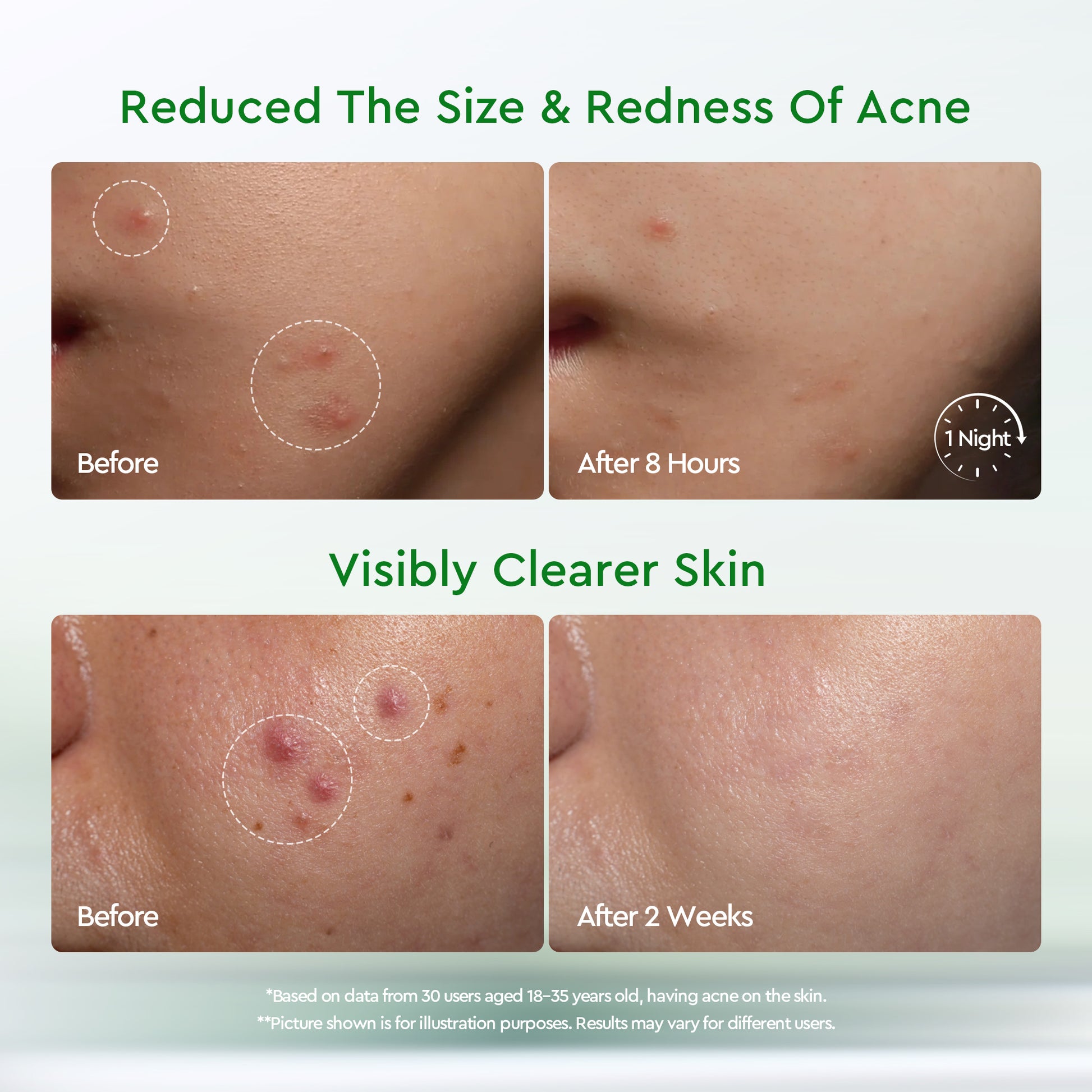 GLAD2GLOW ACNE DRYING LOTION 10ML