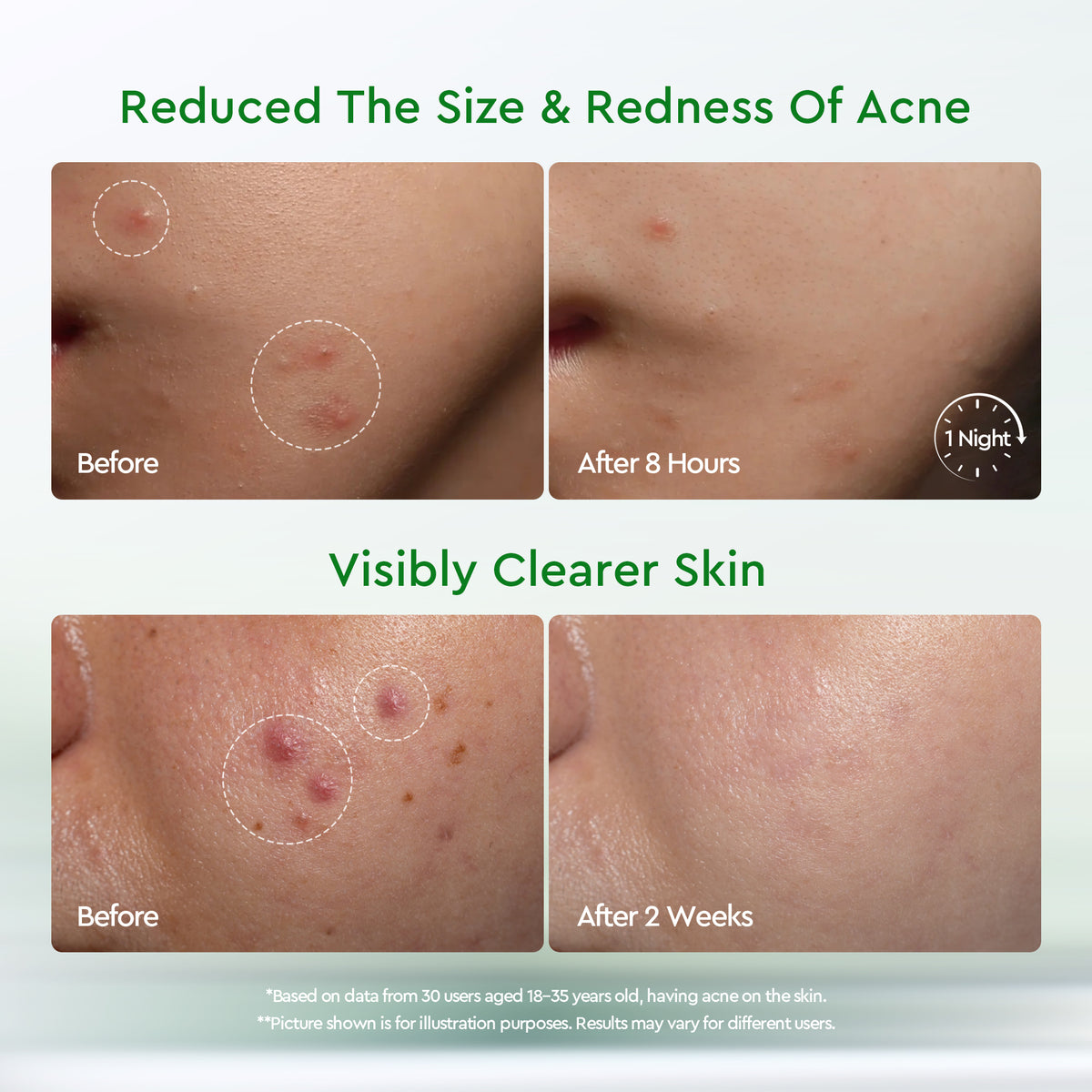 GLAD2GLOW ACNE DRYING LOTION 10ML