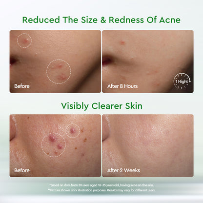GLAD2GLOW ACNE DRYING LOTION 10ML